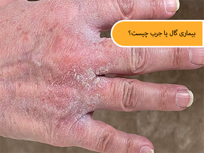 بیماری گال یا جرب چیست؟